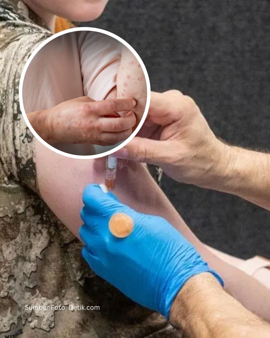 Kasus Campak Melonjak di Indonesia, IDAI Salahkan Gerakan Antivaksin